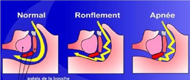 ronflement